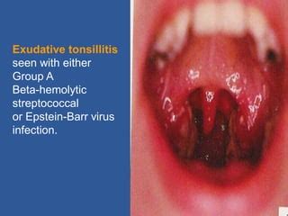 beta strep|Tonsillitis .
